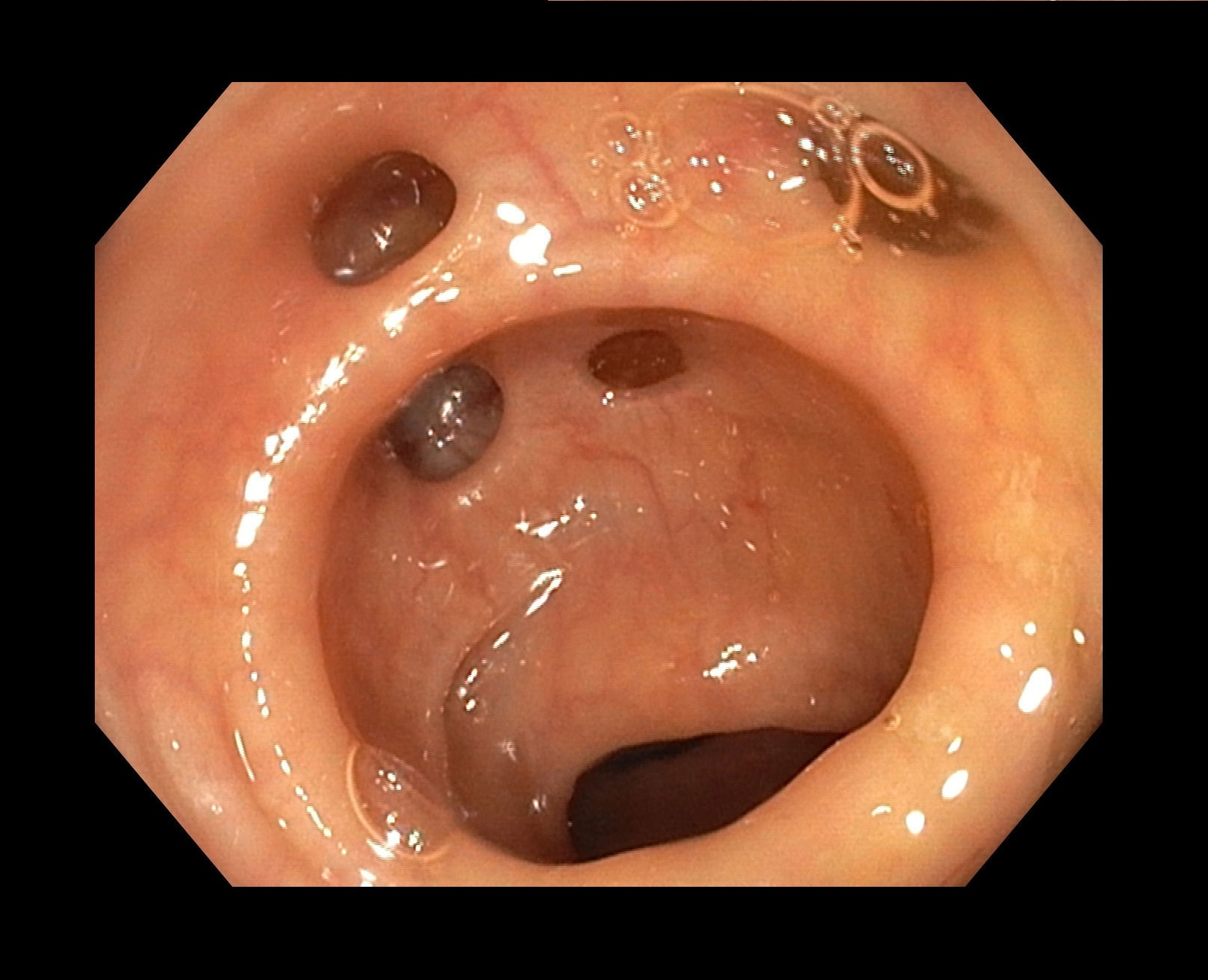 Diverticulose.jpg